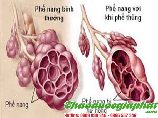 dieu-tri-tieu-thung-hieu-qua-tai-quan-tan-binh.