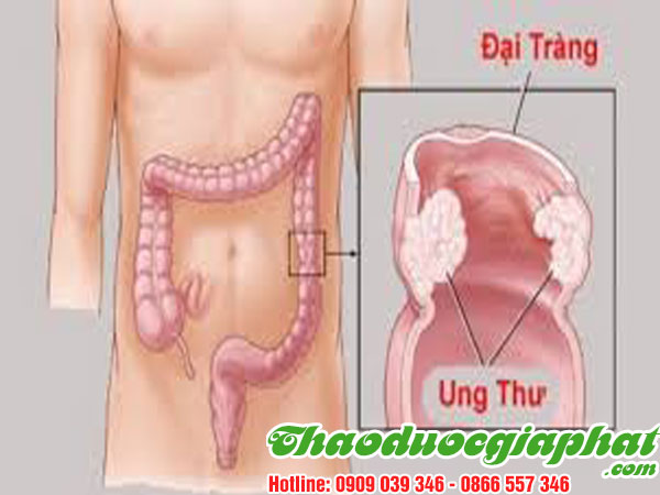 giup-dieu-tri-u-dai-trang-hieu-qua-tai-quan-8