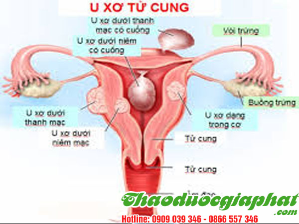 giup-dieu-tri-u-xo-tu-cung-hieu-qua-tai-quan-11