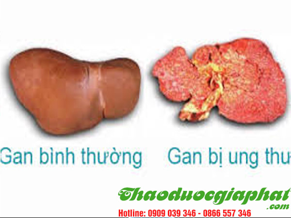 giup-dieu-tri-ung-thu-gan-hieu-qua-tai-quan-7
