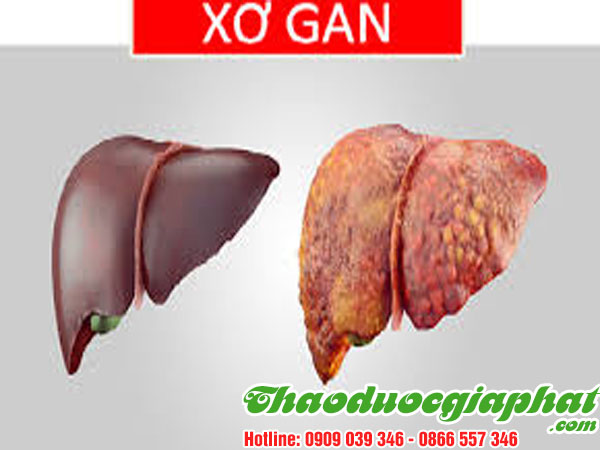 giup-dieu-tri-xo-gan-hieu-qua-tai-quan-3