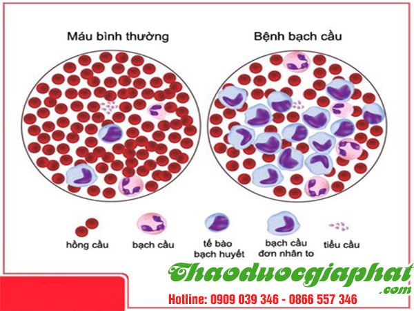 ho-tro-dieu-tri-benh-bach-cau-cap-tinh-hieu-qua-tai-huyen-hoc-mon