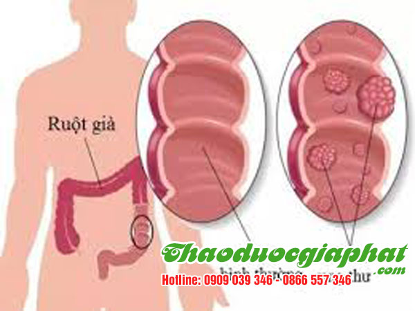 hoa-du-du-duc-dieu-tri-ung-thu-ruot-tai-quan-8