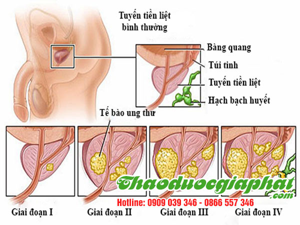 hoa-du-du-duc-giup-dieu-tri-ung-thu-tuyen-tien-liet-tai-quan-go-vap