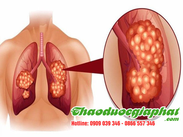 hoa-du-du-duc-tri-ung-thu-phoi-tai-quan-11