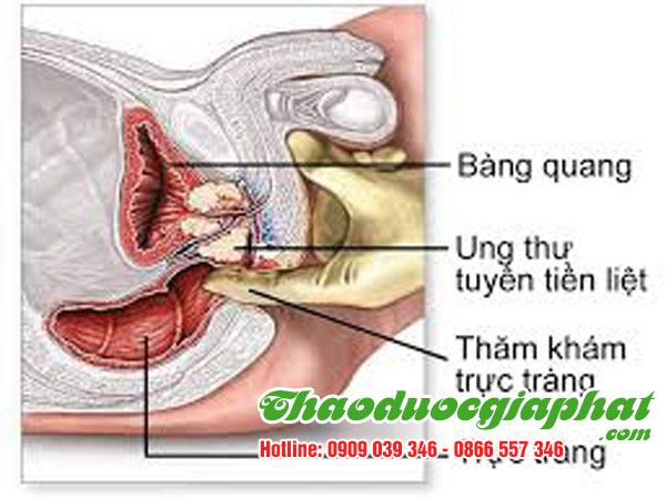 hoa-du-du-duc-tri-ung-thu-tuyen-tien-liet-tai-quan-binh-thanh
