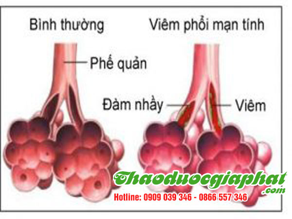 hoa-du-du-duc-tri-viem-cuong-phoi-tai-quan-tan-phu.