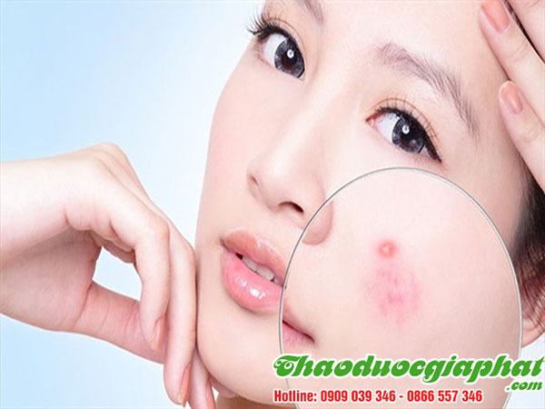 kim-tien-thao-tai-quan-go-vap-tri-mun-nhot-hieu-qua-nhat