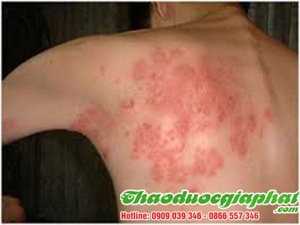la-don-do-tai-huyen-binh-chanh-chat-luong-giup-chua-tri-zona-tot-nhat