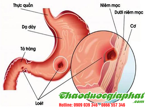 la-don-do-tai-huyen-nha-be-chat-luong-viem-loet-man-tinh-tot-nhat