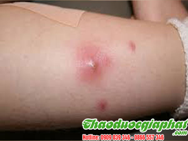 la-don-do-tai-quan-3-chat-luong-tri-benh-mun-nhot-tot-nhat