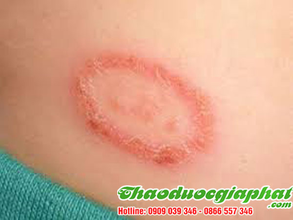 la-don-do-tai-quan-7-chat-luong-tri-benh-zona-tot-nhat