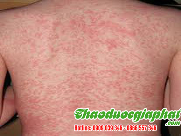 la-don-do-tai-quan-8-chat-luong-tri-benh-lỡ-ngua-tot-nhat