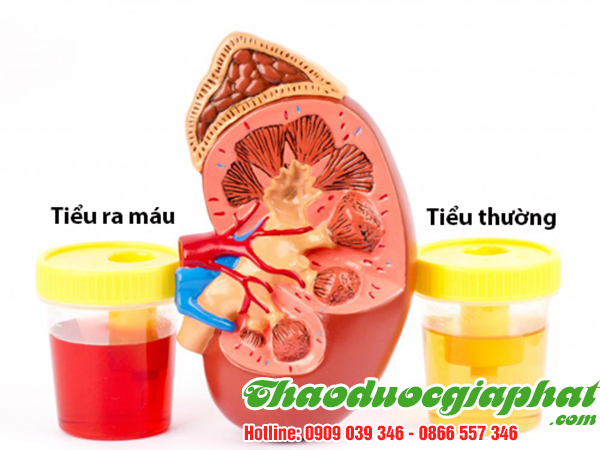 la-don-do-tai-quan-binh-thanh-chat-luong-tri-tieu-ra-mau-tot-nhat