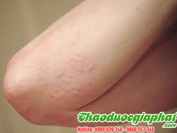 la-don-do-tai-quan-go-vap-chat-luong-tri-di-ung-tot-nhat