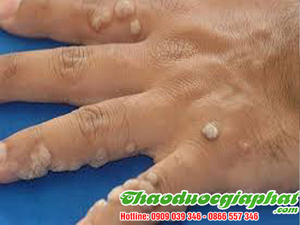 mua-ban-cay-giao-xuong-ca-uy-tin-chat-luong-tai-quan-6-tri-mun-coc