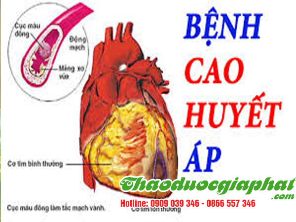 mua-ban-che-day-uy-tin-chat-luong-tại-quan-1-tri-cao-huyet-ap