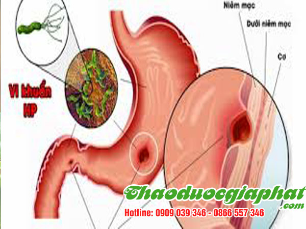 mua-ban-che-day-uy-tin-chat-luong-tại-quan-2-tri-dau-da-day