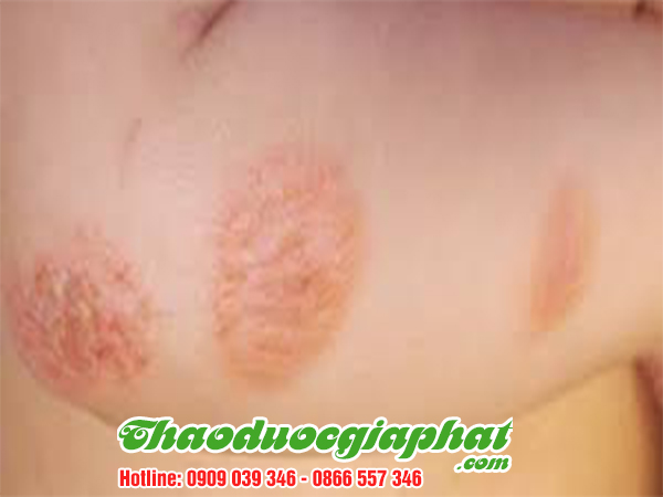 mua-ban-nu-voi-la-voi-tai-quan-8-hieu-qua-tri-viem-da
