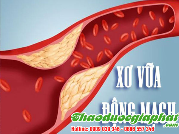 qua-kha-tu-dieu-tri-benh-so-vua-dong-mach-tai-huyen-binh-chanh-tot-nhat