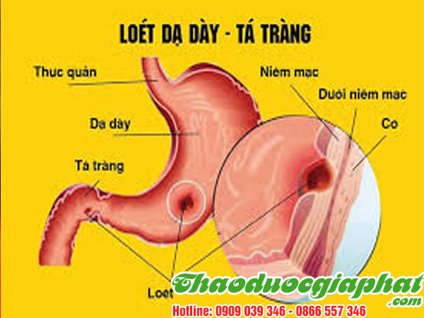qua-sung-dieu-tri-viem-loet-da-day-ta-trang-tai-quan-9.