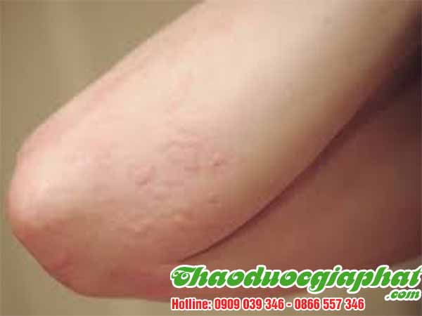 rau-den-gai-tri-viem-da-tai-quan-6