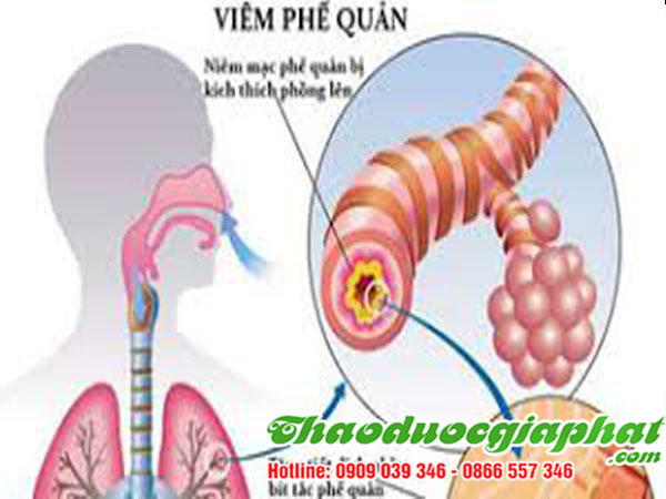 sam-dai-hanh-dieu-tri-viem-phe-quan-tai-quan-10