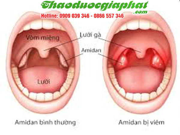 sam-dai-hanh-giup-dieu-tri-viem-amidan-tai-quan-9