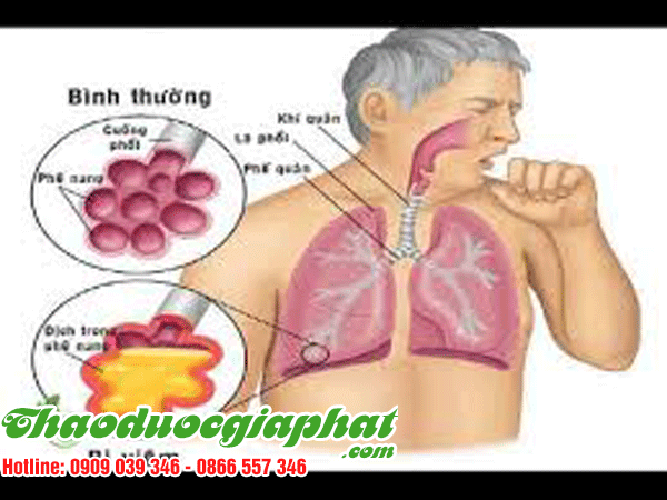 cay-kien-co-tri-viem-phe-quan-tai-quan-5-tot-nhat