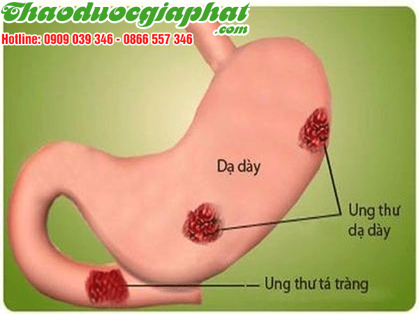 ung-thu-da-day-huyen-binh-chanh